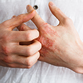 Eczema Work Gloves