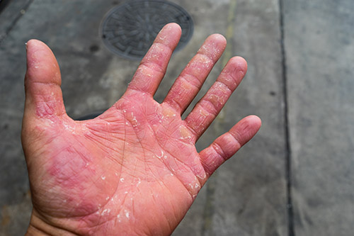 Hand with dermatitis