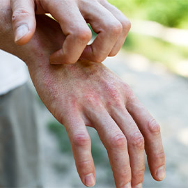 Dermatitis Gloves