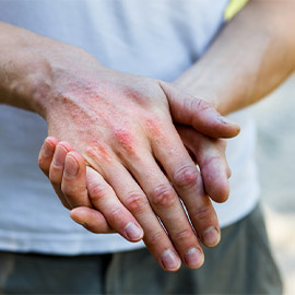 Eczema Gloves